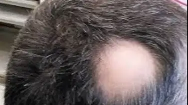 Dile adiós a la calvicie con esta fórmula casera Dile adiós a la calvicie con esta fórmula casera