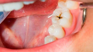 ¿Sabías que las caries no son solo negras?