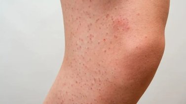 Combate la piel de fresa con estos tips    