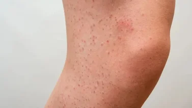 Combate la piel de fresa con estos tips    