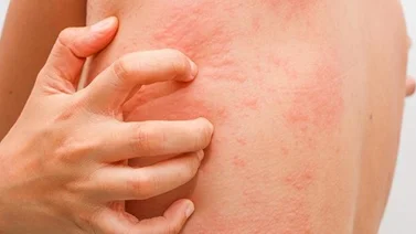 Reacciones alérgicas: ¿Qué hacer en caso de shock anafiláctico?