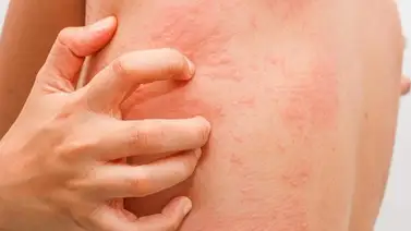 Reacciones alérgicas: ¿Qué hacer en caso de shock anafiláctico? Reacciones alérgicas: ¿Qué hacer en caso de shock anafiláctico?