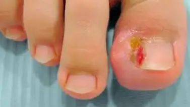 ¿Uña encarnada? Esta es la solución ¿Uña encarnada? Esta es la solución