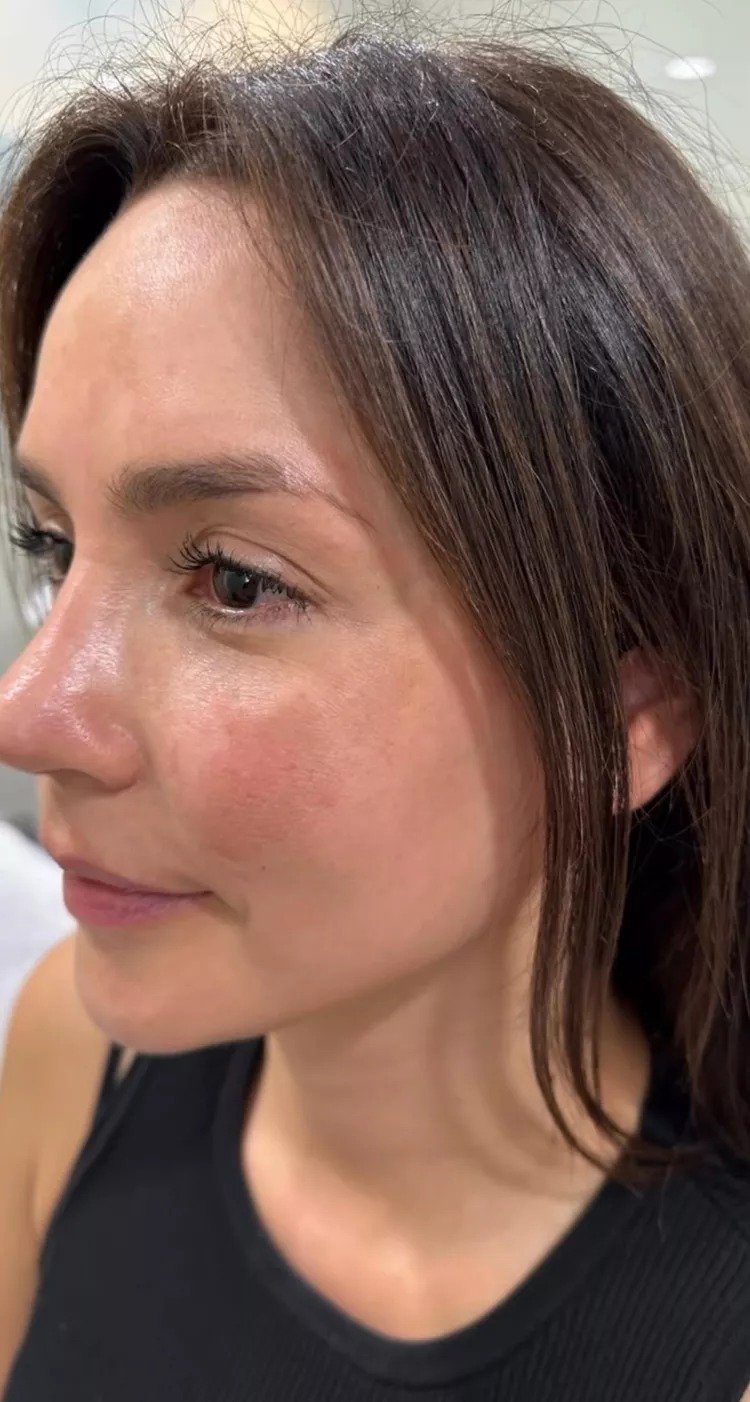 Enfermedad de la piel: Carmen Villalobos muestra avances de su lucha contra el melasma Enfermedad de la piel: Carmen Villalobos muestra avances de su lucha contra el melasma