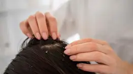 El ingrediente que siempre tienes en casa que ayuda a eliminar la caspa en un “tris”: aprende a aplicarlo para aprovechar su efecto