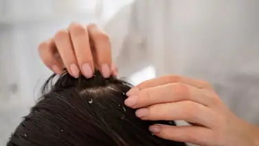 El ingrediente que siempre tienes en casa que ayuda a eliminar la caspa en un “tris”: aprende a aplicarlo para aprovechar su efecto El ingrediente que siempre tienes en casa que ayuda a eliminar la caspa en un “tris”: aprende a aplicarlo para aprovechar su efecto