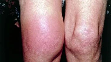 Desinflama las rodillas con este remedio casero fácil de preparar