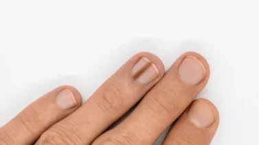 ¿Por qué salen manchas negras en las uñas y cómo eliminarlas? 