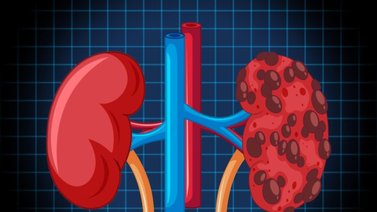 Entérate de cuál es el poderoso remedio casero para eliminar los cálculos renales