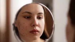 ¡No más brotes de acné!: Consejos que te ayudan a lucir un cutis impecable