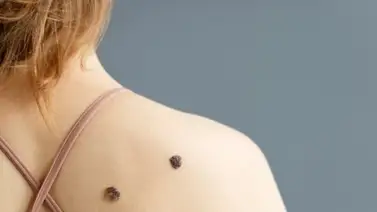 Esto te puede pasar si te arrancas una verruga ¡Cuidado! Esto te puede pasar si te arrancas una verruga ¡Cuidado!