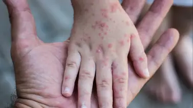 Sarampión en USA: cómo prevenir su contagio Sarampión en USA: cómo prevenir su contagio