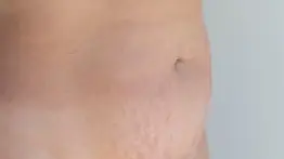 Elimina las estrías con esta crema natural a base de aceite de oliva: solo debes aplicarla una vez al día