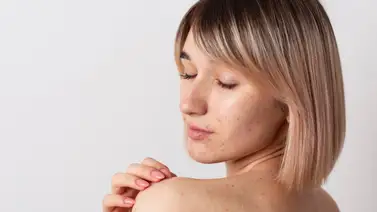 Hábitos que ayudan a combatir el acné en la espalda: sin invertir altas sumas de dinero y desde la comodidad de la casa Hábitos que ayudan a combatir el acné en la espalda: sin invertir altas sumas de dinero y desde la comodidad de la casa