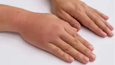 La inflamación como mecanismo de defensa y curación del cuerpo: un Nobel de Medicina revela secreto sorprendente La inflamación como mecanismo de defensa y curación del cuerpo: un Nobel de Medicina revela secreto sorprendente