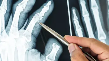 Alerta en las articulaciones: la artrosis aparece décadas antes de lo previsto Alerta en las articulaciones: la artrosis aparece décadas antes de lo previsto