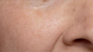 Dile adiós a los poros dilatados con esta mascarilla de piña: así debes utilizarla