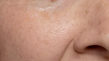 Dile adiós a los poros dilatados con esta mascarilla de piña: así debes utilizarla