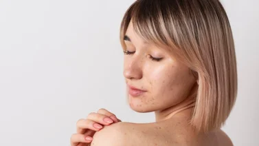 Así debes utilizar el limón para aclarar las manchas en la piel