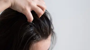 ¡Cabello limpio! Elimina la grasa con este ingrediente de cocina rico en vitaminas ¡Cabello limpio! Elimina la grasa con este ingrediente de cocina rico en vitaminas