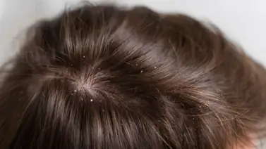 ¿Tienes caspa? Aprende cómo debes aplicar el romero para eliminarla ¿Tienes caspa? Aprende cómo debes aplicar el romero para eliminarla