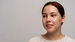 Aclara las manchas del rostro con perejil: esta es la manera correcta de utilizarlo