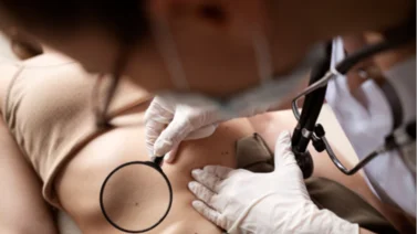 ¿Tienes lunares? Reconoce si son benignos o malignos