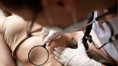 ¿Tienes lunares? Reconoce si son benignos o malignos ¿Tienes lunares? Reconoce si son benignos o malignos