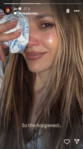 Jennifer Lopez sufre lesión en su rostro tras una caída: así le quedó la nariz por el golpe Jennifer Lopez sufre lesión en su rostro tras una caída: así le quedó la nariz por el golpe