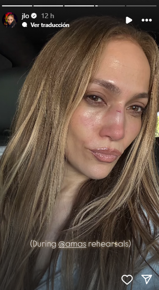 Jennifer Lopez sufre lesión en su rostro tras una caída: así le quedó la nariz por el golpe