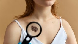 La sombra en tu piel: desvelando los secretos del melanoma que podrían salvarte