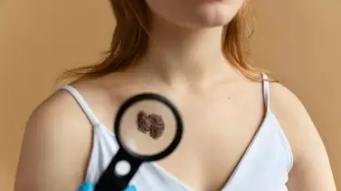 La sombra en tu piel: desvelando los secretos del melanoma que podrían salvarte La sombra en tu piel: desvelando los secretos del melanoma que podrían salvarte