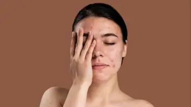 Fórmula natural para desmanchar la piel: prepárala a base de limón en simples pasos Fórmula natural para desmanchar la piel: prepárala a base de limón en simples pasos
