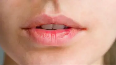 El impacto de la hidratación de labios en la salud de la sonrisa: estos son los cuidado dermatológico El impacto de la hidratación de labios en la salud de la sonrisa: estos son los cuidado dermatológico