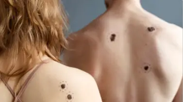 Alerta médica en dermatología: el incremento de tumores cutáneos y la importancia de la prevención Alerta médica en dermatología: el incremento de tumores cutáneos y la importancia de la prevención