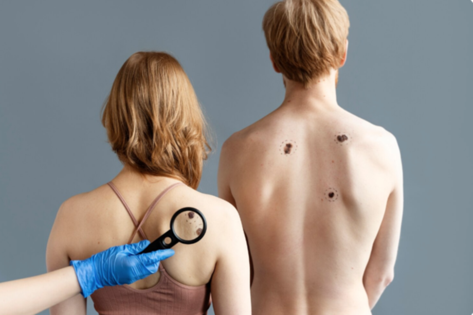 Alerta médica en dermatología: el incremento de tumores cutáneos y la importancia de la prevención