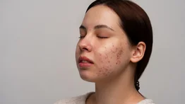Elimina las manchas de la piel con esta económica mascarilla a base de aloe vera
