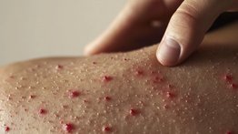 Revelan los lugares en los que hay brotes de sarampión: personas que hayan estado allí debe estar atentas a los síntomas