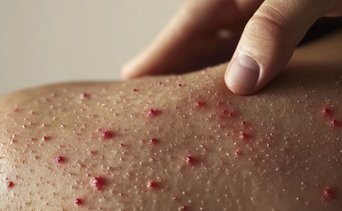 Revelan los lugares en los que hay brotes de sarampión: personas que hayan estado allí debe estar atentas a los síntomas