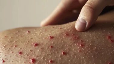 Revelan los lugares en los que hay brotes de sarampión: personas que hayan estado allí debe estar atentas a los síntomas