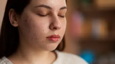 Puntos negros: cómo acabar con esta amenaza que destruye tu piel  Puntos negros: cómo acabar con esta amenaza que destruye tu piel