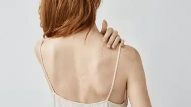 Lo que tu piel necesita: el arma secreta para combatir las manchas  Lo que tu piel necesita: el arma secreta para combatir las manchas