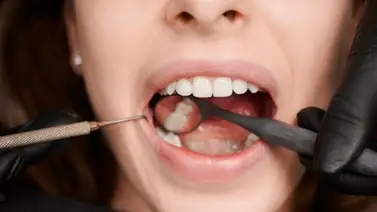 Fórmula natural a base de limón para blanquear los dientes: esta es la cantidad que debes aplicar para aprovechar el efecto Fórmula natural a base de limón para blanquear los dientes: esta es la cantidad que debes aplicar para aprovechar el efecto