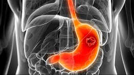 Más de 15 millones de personas a nivel mundial podrían padecer cáncer de estómago: revelan la principal causa