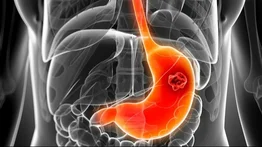 Más de 15 millones de personas a nivel mundial podrían padecer cáncer de estómago: revelan la principal causa