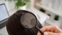 Despídete de la caspa: con este ingrediente que todos tenemos en casa tendrás una melena sana y brillante