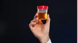 Señal de alarma: Entérate qué revela el color de la orina acerca de tu estado de salud