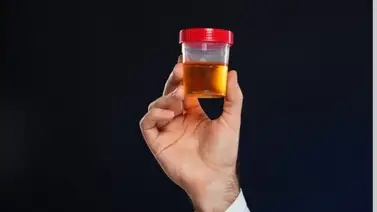 Señal de alarma: Entérate qué revela el color de la orina acerca de tu estado de salud Señal de alarma: Entérate qué revela el color de la orina acerca de tu estado de salud