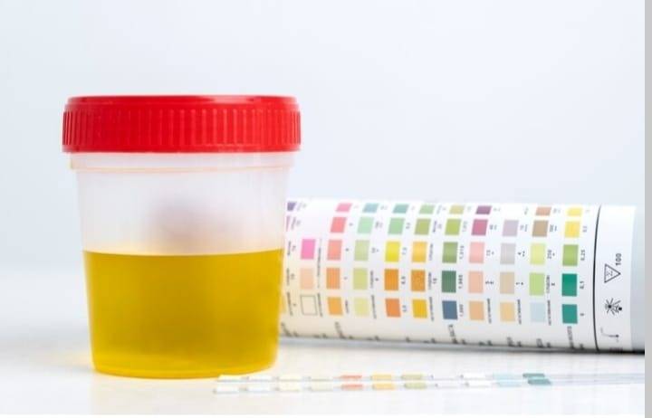 Señal de alarma: Entérate qué revela el color de la orina acerca de tu estado de salud
