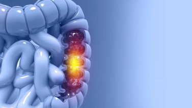 Aprueban rápido método para detectar el cáncer de colon: sepa cuál